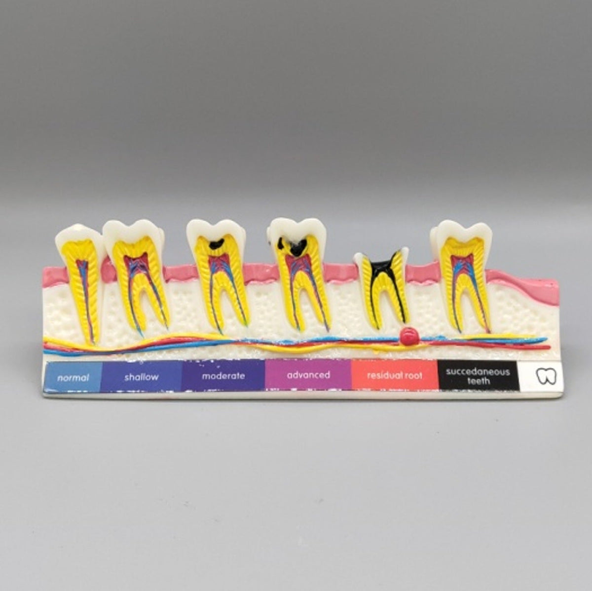 Tooth Caries Model